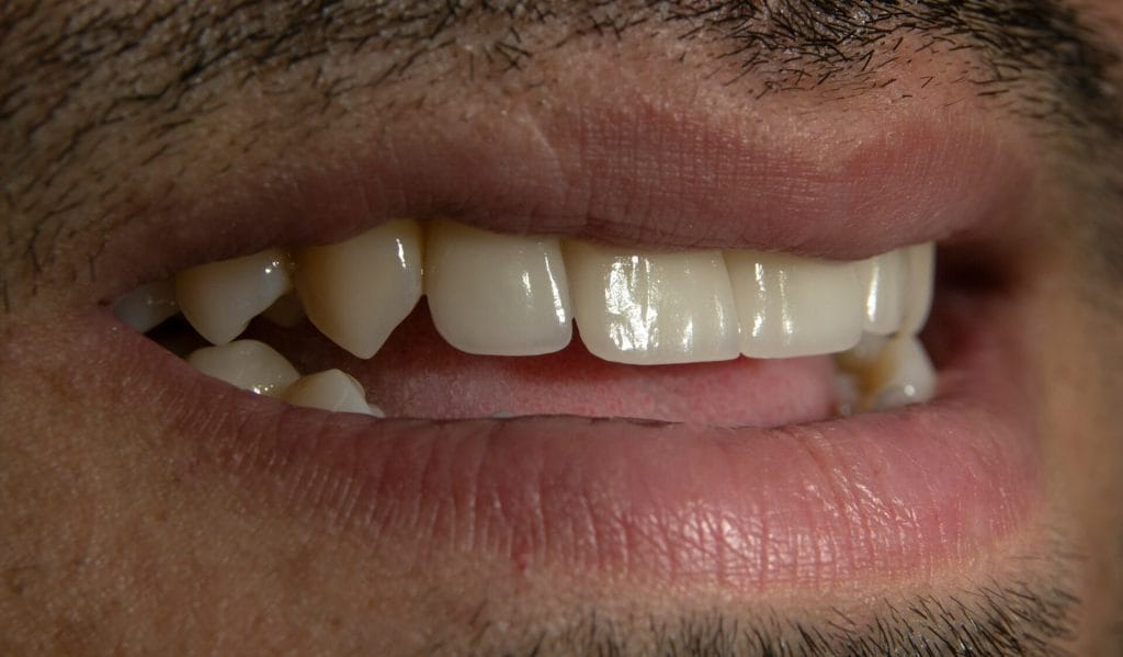 Quali alimenti macchiano i denti