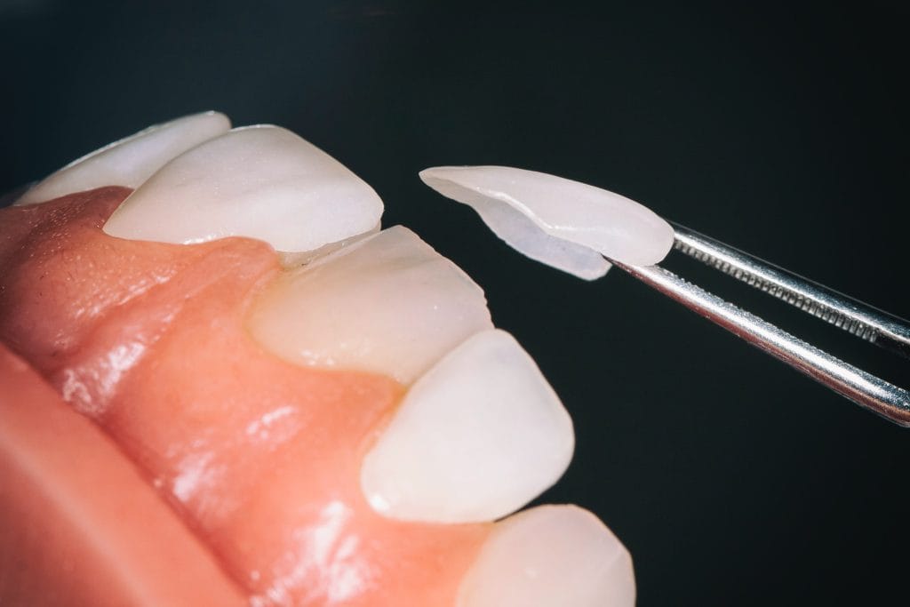 Faccette dentali